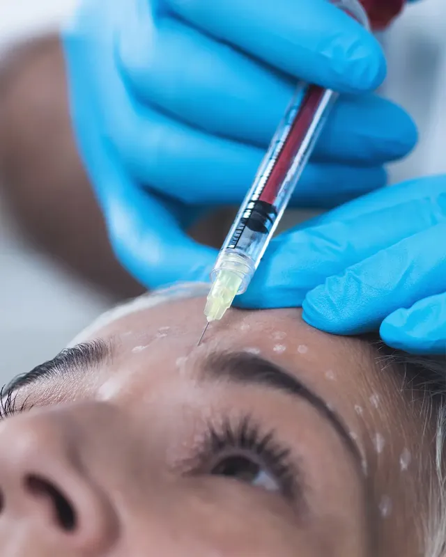 Injection Botox® rides du lion à Toulouse