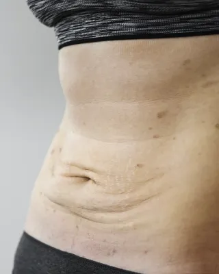 Correction esthétique de la paroi abdominale