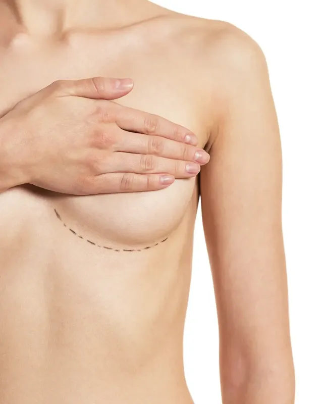 Lipostructure des seins reconstruits après mastectomie à Toulouse