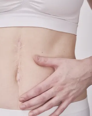 Chirurgie des cicatrices