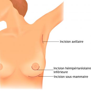 Cicatrices