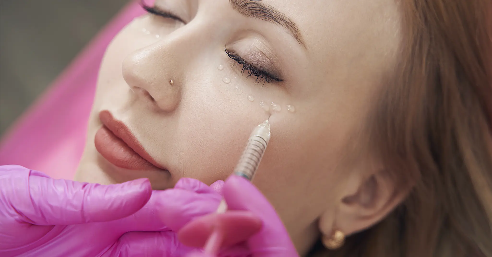 Injection acide hyaluronique cernes